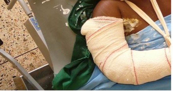 Un Tailleur évèrement battu par ses collègues et se retrouve avec une fracture du nez et du bras Un Tailleur évèrement battu par ses collègues et se retrouve avec une fracture du nez et du bras