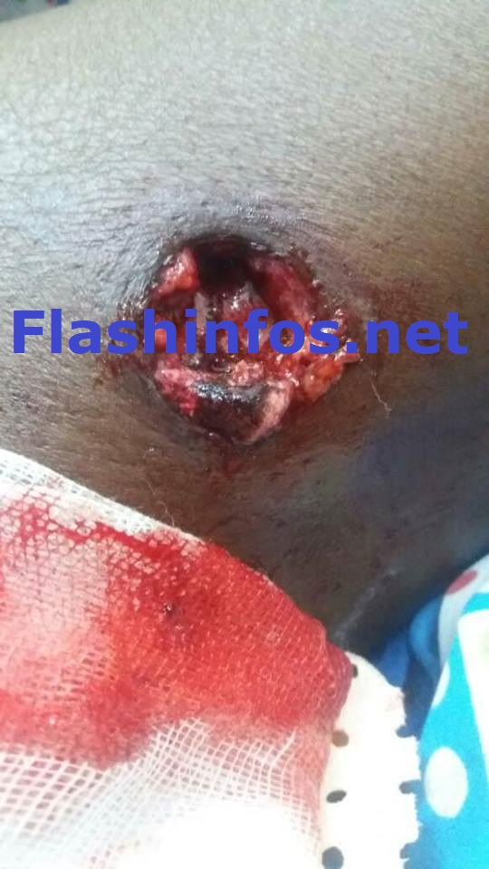 Ziguinchor : Une militante du Pds blessée par une balle perdue tirée par la police