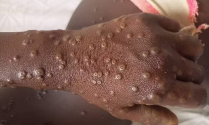 Mpox : Un deuxième cas confirmé,  les autorités sanitaires appellent à la vigilance