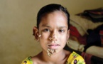 Un premier cas mondial de "femme-arbre" au Bangladesh ?
