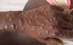 Mpox : Un deuxième cas confirmé,  les autorités sanitaires appellent à la vigilance